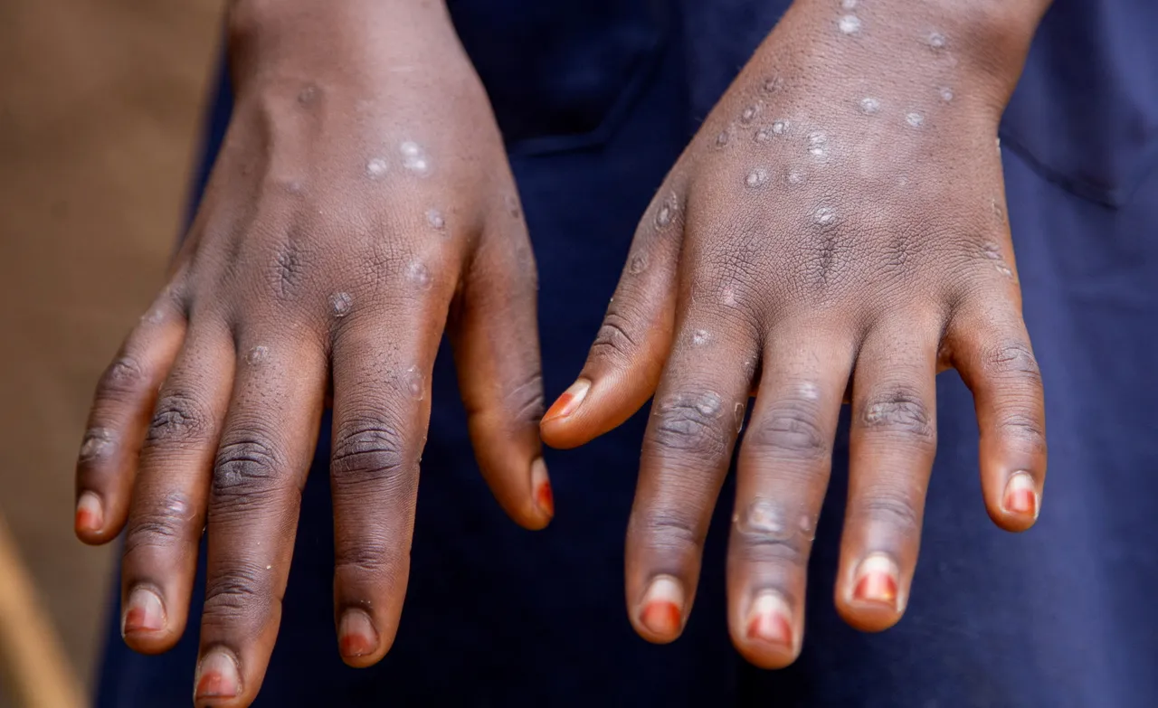 Stigma, myth and scale worsen Africa’s mpox crisis